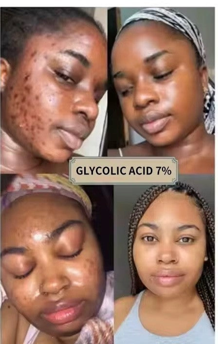 Glycolic Acid 7% Exfoliating Toner.